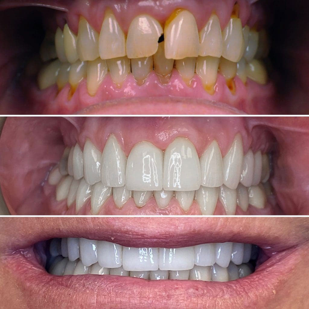 The image displays a collage of three photos featuring a person s teeth transformation. The top photo shows yellowed teeth, the middle photo depicts a smile with white fillings and teeth whitening, and the bottom photo features a close-up of a clean, white smile.