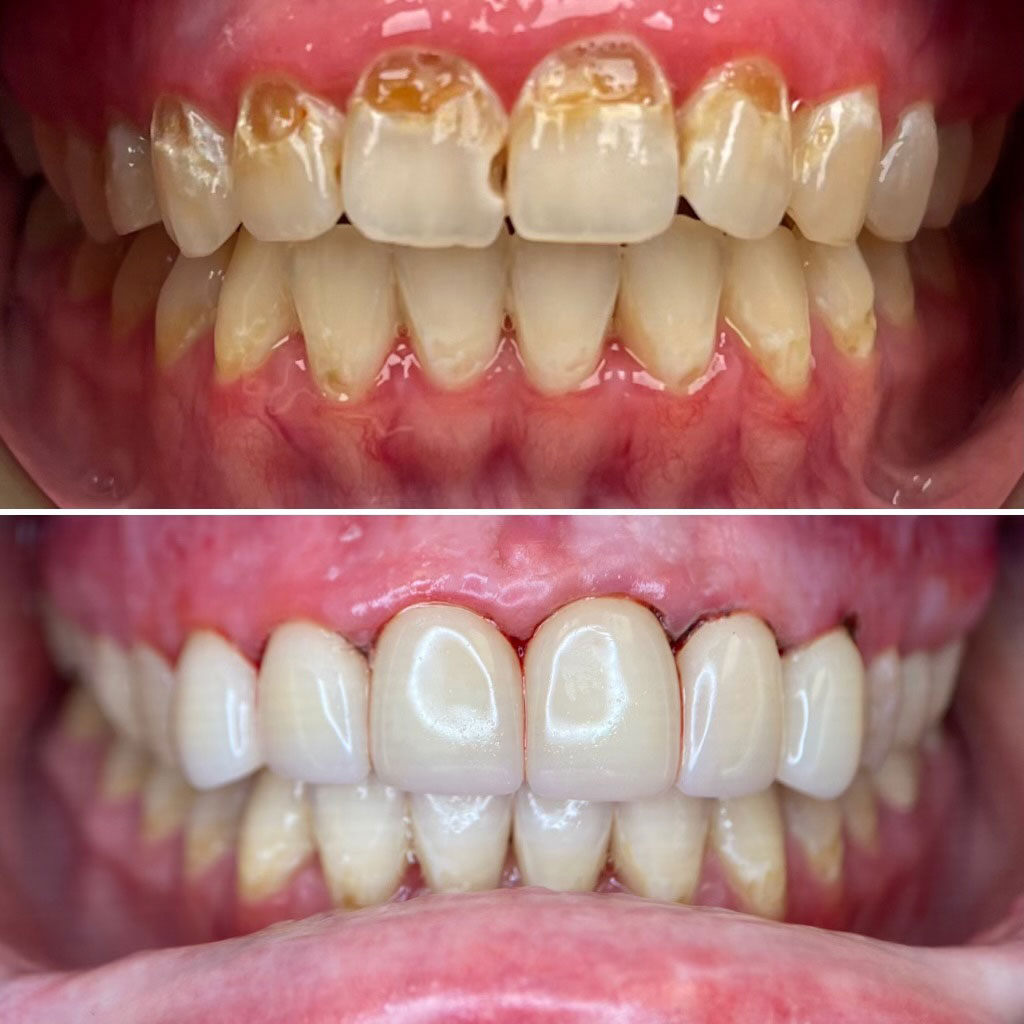 The image displays a side-by-side comparison of two sets of teeth, with the left side showing a set of yellowed teeth and the right side showing a set of clean, white teeth.