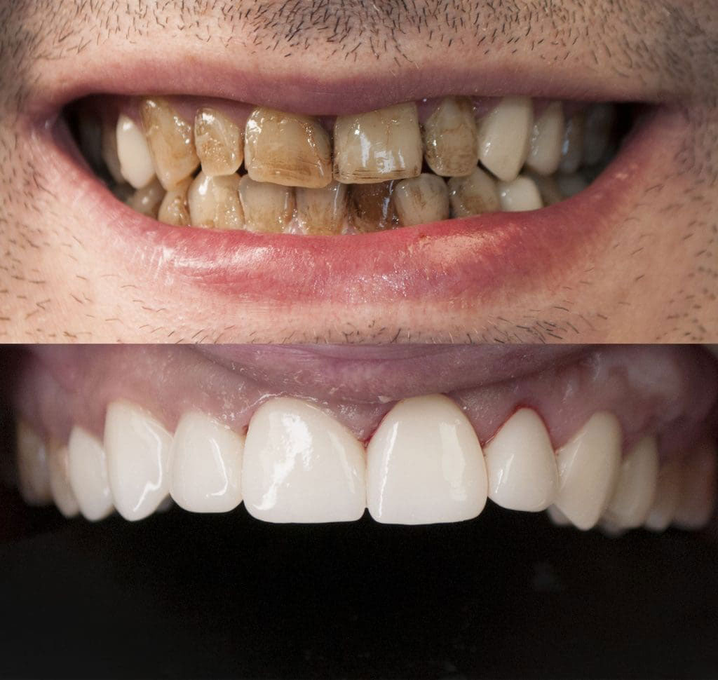 Before and after dental treatment comparison, showing a dramatic improvement in teeth whiteness.
