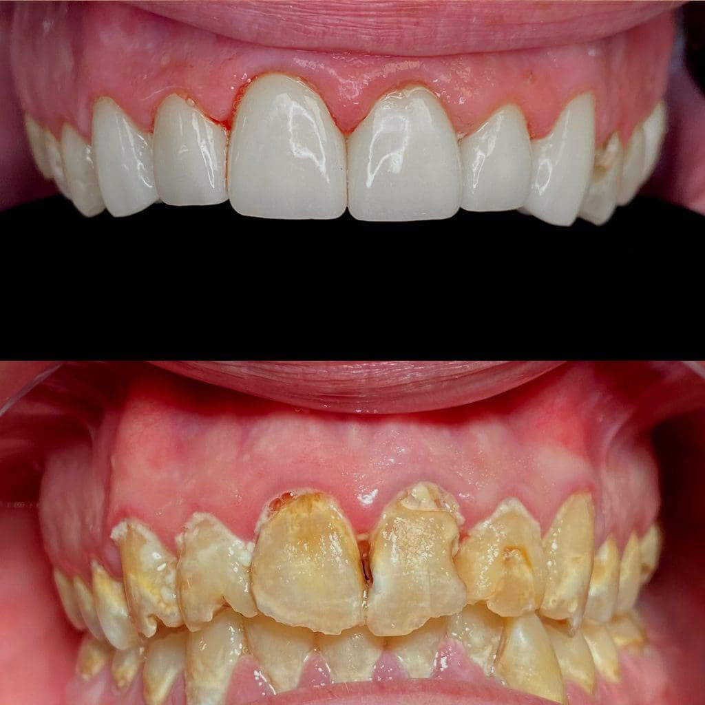 The image shows a side-by-side comparison of two dental implants with different levels of staining, highlighting the effectiveness of teeth whitening treatments.