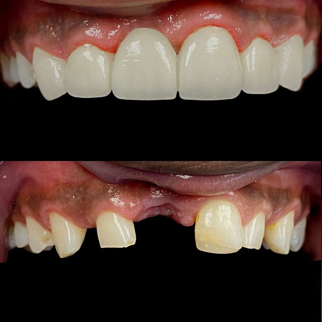 The image shows a close-up of two dental implants with visible gum tissue, one on the left and one on the right, against a black background.