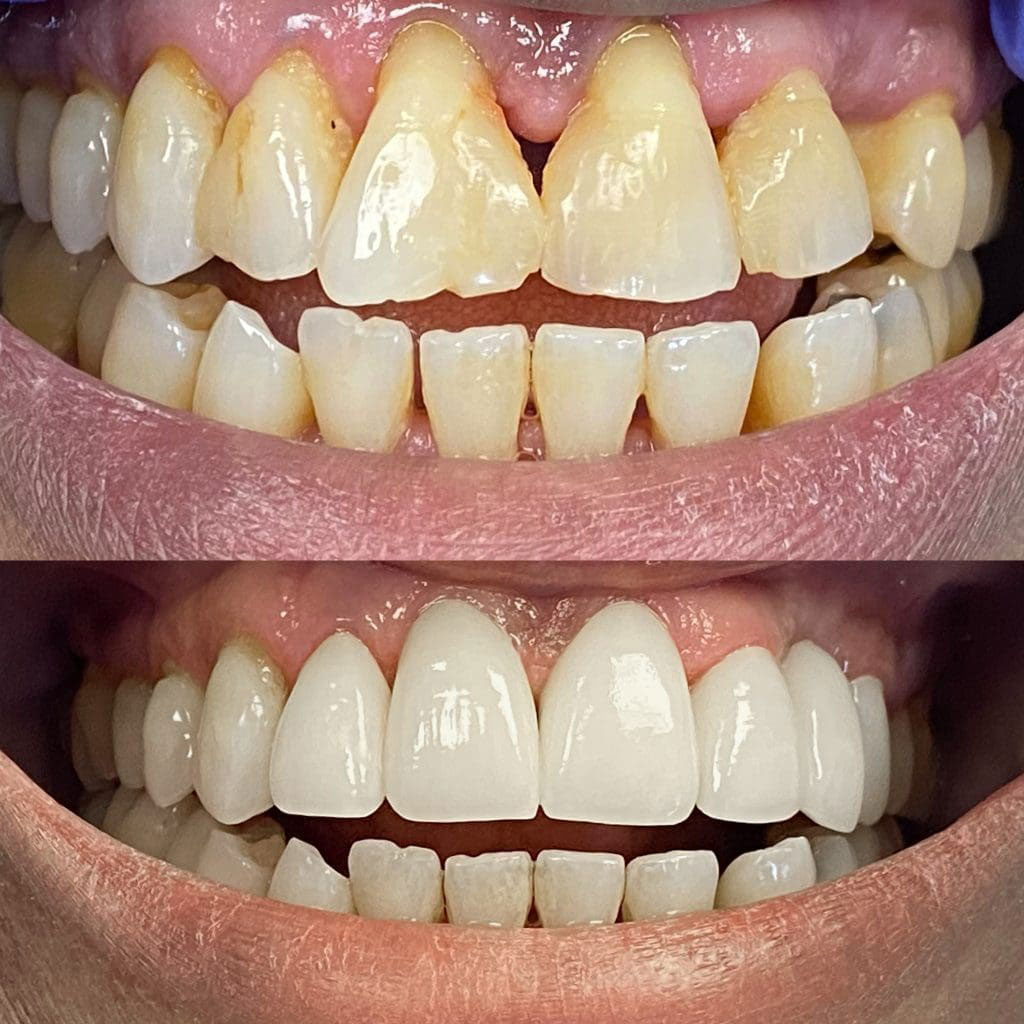 The image displays a side-by-side comparison of two sets of teeth, one showing a yellowed and discolored appearance and the other displaying a clean, white smile after dental treatment.