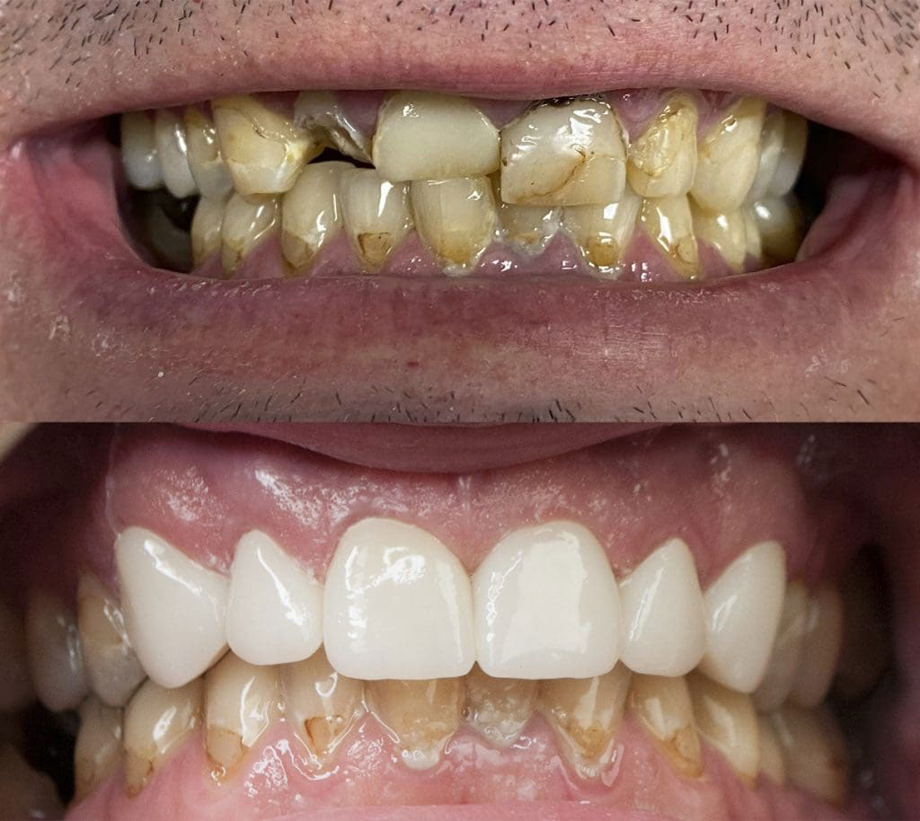 The image displays a side-by-side comparison of dental treatments, with one half showing a mouth with visible stains and discoloration, and the other half displaying a cleaner, brighter smile after what appears to be professional teeth whitening.