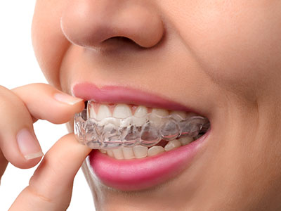 The image shows a person with an Invisalign aligner in their mouth, examining it closely.