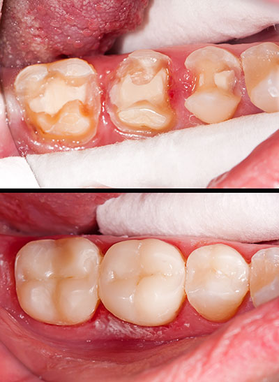 The image shows a person s mouth with teeth that have been restored or are in the process of being restored, indicating dental work.