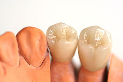 This image shows a set of artificial teeth with varying shades of yellow, placed alongside a pair of human-like teeth.