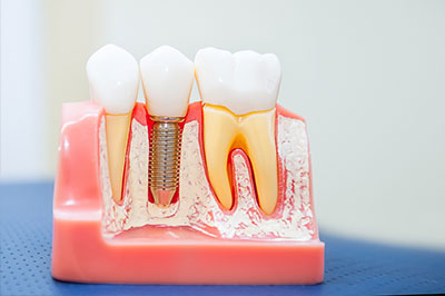 The image shows a close-up of a dental model with multiple teeth, some of which have visible fillings and an implant.