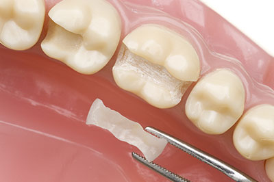 The image shows a close-up of a dental implant being placed into an upper jaw tooth socket, with a surgical instrument and a small piece of bone graft material visible.