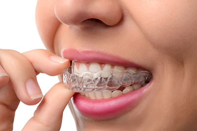 A person wearing a clear braces appliance with their hand to their mouth, showing the braces in detail.