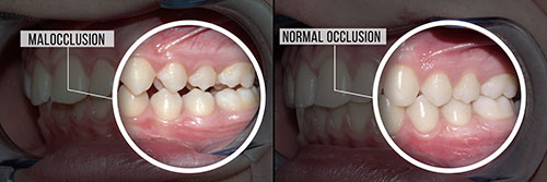 The image shows a side-by-side comparison of a human mouth with teeth, one with natural teeth and the other with artificial teeth.