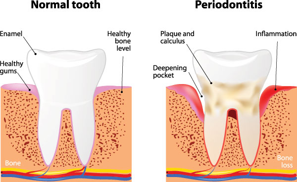 The image is a medical illustration depicting the progression of gum disease from normal to periodontitis, with annotations explaining the stages and their symptoms.