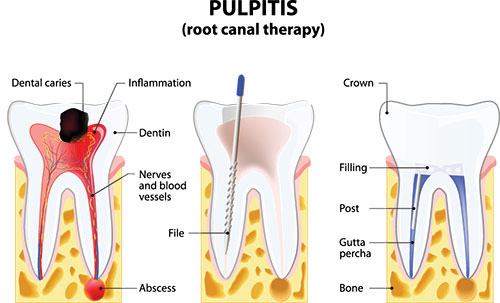 The image is an educational illustration showing a cross-section of a tooth with its root canal system, labeled to explain the structure and function of dental pulpitis.