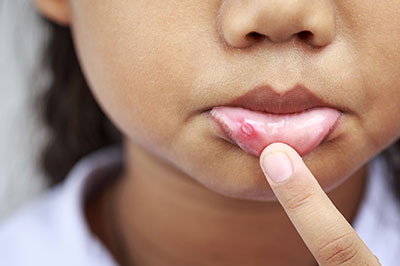 The image shows a close-up of a child s face with a finger pointing at a pimple on their lower lip.