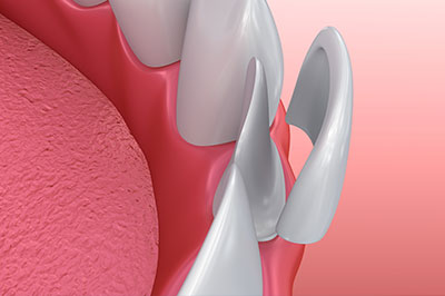 The image displays a close-up of a dental implant fixture with a screw, set against a red background that resembles gum tissue.