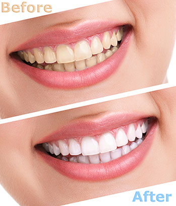 Before and after image of a woman s teeth whitening transformation, with two photos side by side showing a dramatic improvement in tooth color.