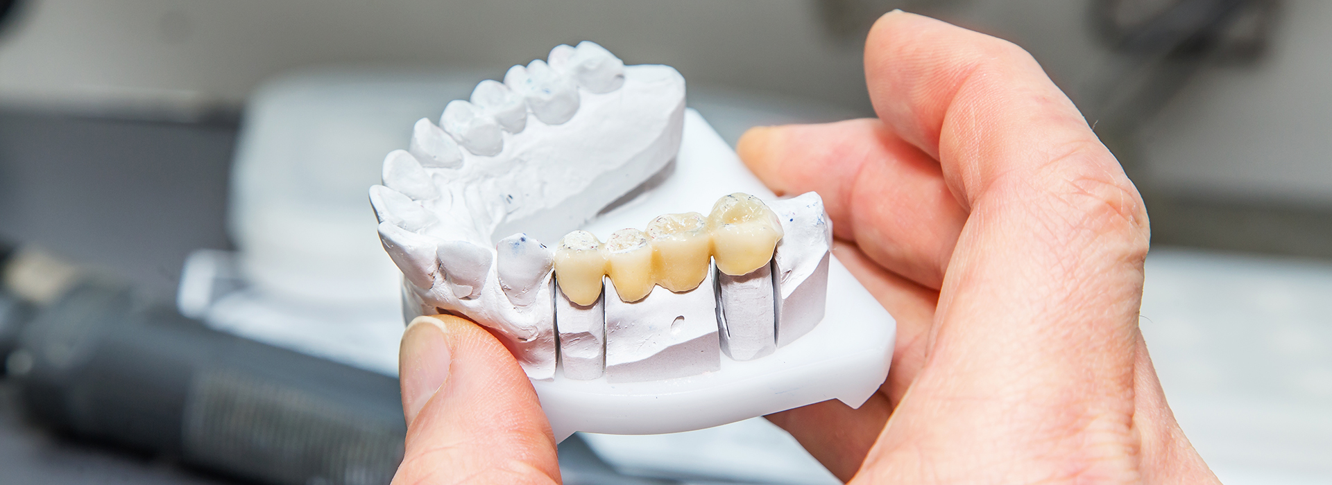 Person holding a 3D printed dental model with missing teeth.