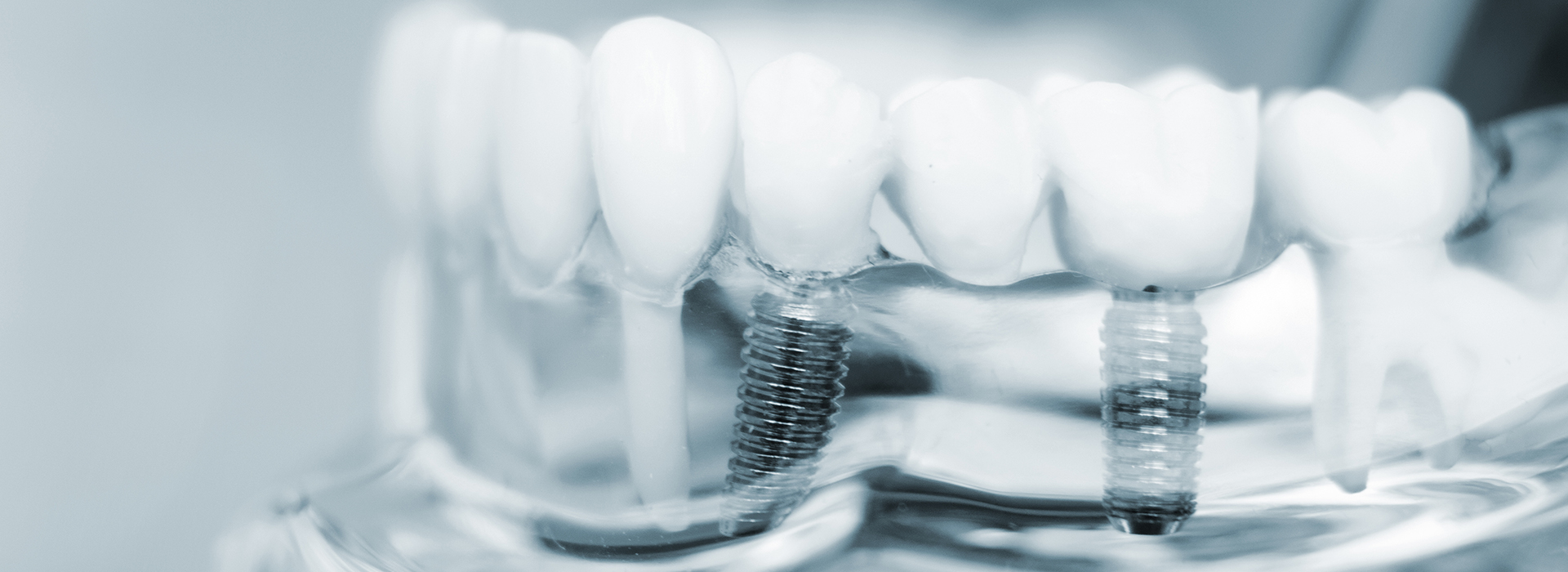 Close-up of a transparent dental implant with screws and abutments, set against a blurred background.