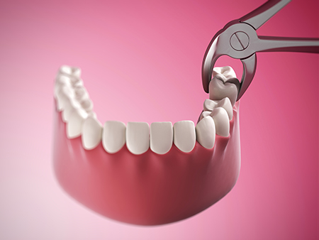Newpoint Family Dental | Dental Fillings, Dentures and Dental Sealants